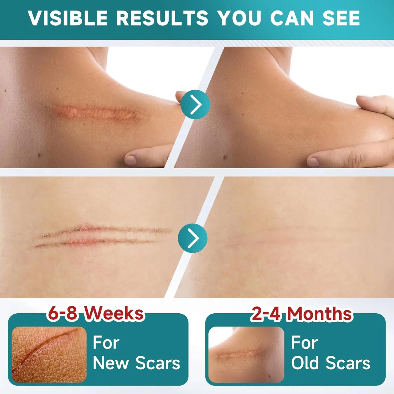 Silicone Scar Sheets, Silicone Scar Tape(1.6” x 120” Roll-3M), Scar Removal Away Strips for Surgical Scars, Keloid, C-Section, Burn et